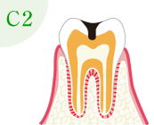 むし歯の進行：C2