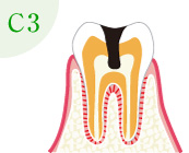 むし歯の進行：C3