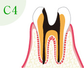 むし歯の進行：C4